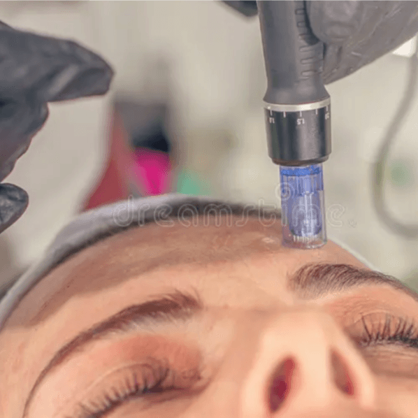 3 Microneedling Sessions at Fuzzy Peach in Boulder, CO